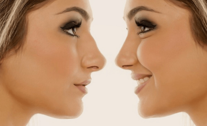 Sculpting Elegance: Navigating of Rhinoplasty in Turkey(图1)