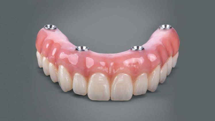 The Definitive Guide to All-on-4 Dental Implants: Advantages, Procedure(图1)